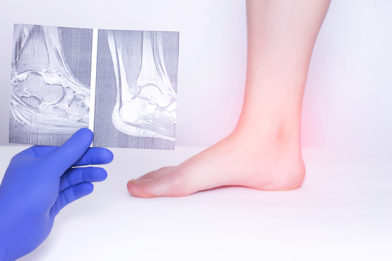 علت درد گرفتن مچ پا هنگام پیاده روی - 1 - علت درد گرفتن مچ پا هنگام پیاده روی