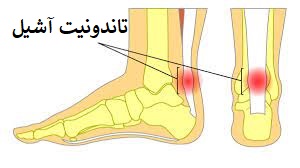 علت درد گرفتن مچ پا هنگام پیاده روی - 2 - علت درد گرفتن مچ پا هنگام پیاده روی