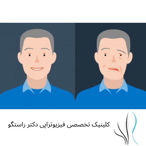 فلج عضلات صورت  فیزیوتراپی فلج بلز - 1 1 - فیزیوتراپی فلج بلز