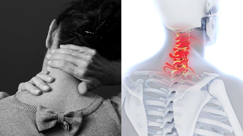 عکس آرتروز گردن درمان آرتروز گردن - 1 1024x576 - درمان آرتروز گردن