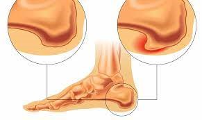 درمان خار پاشنه پا با شاک ویو تراپی درمان خار پاشنه پا با شاک ویو تراپی - 2 - درمان خار پاشنه پا با شاک ویو تراپی