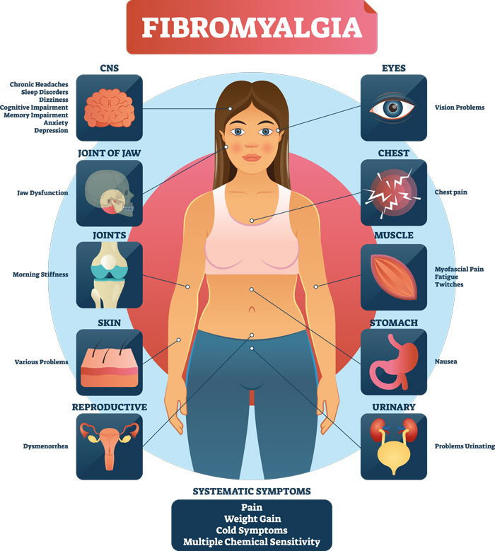 نقاط درد فیبرومیالژیا فیبرومیالژیا چیست و درمان آن - Fibromyalgia 3 - فیبرومیالژیا چیست و درمان آن