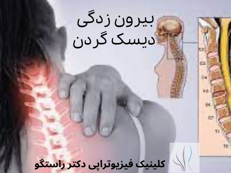 فتق دیسک گردن چیست فتق دیسک گردن و درمان آن - 1 - فتق دیسک گردن و درمان آن