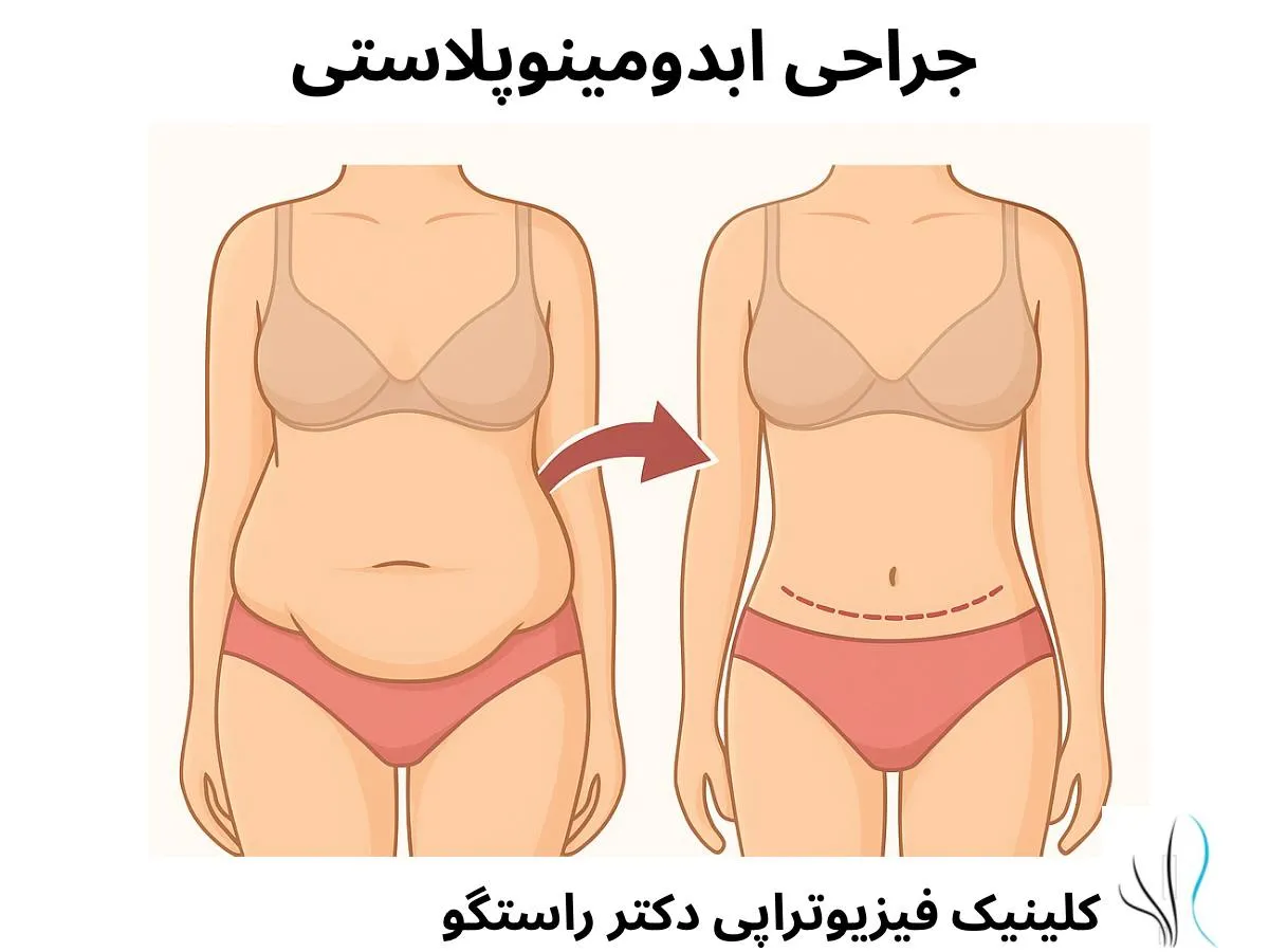 ابدومینوپلاستی